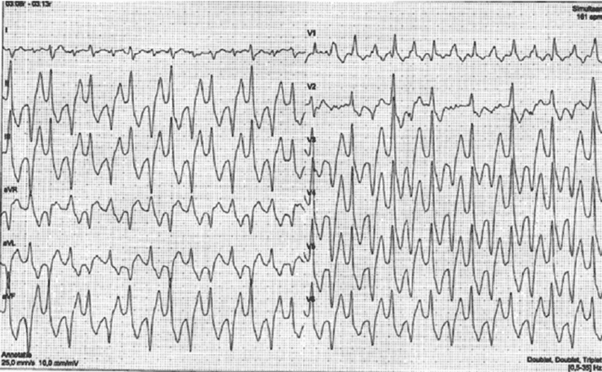 Figure 1. Bidirectional ventricular tachycardia. Source: